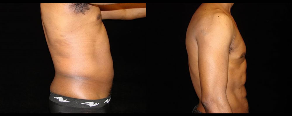 Six Pack Abs Before & After Patient #1145