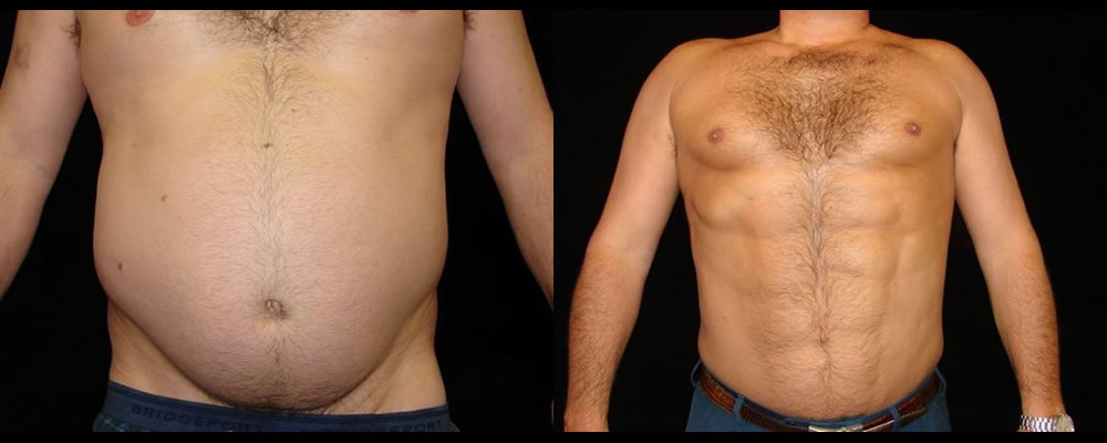 Six Pack Abs Before & After Patient #1141