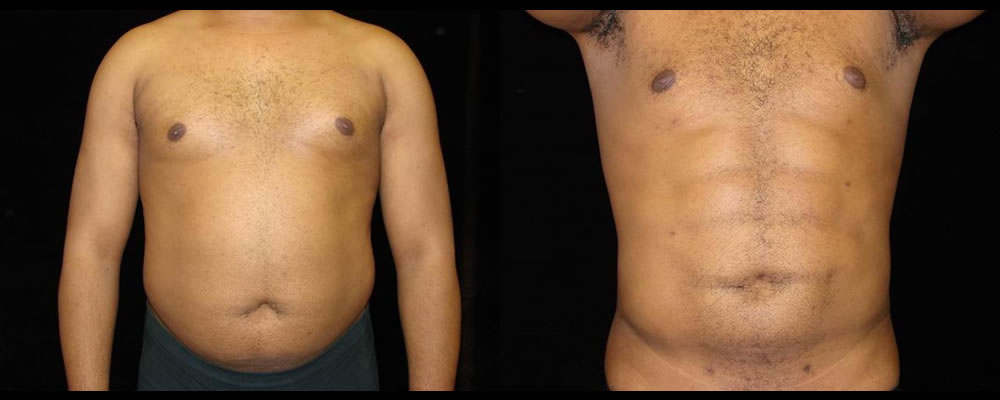 Six Pack Abs Before & After Patient #1137