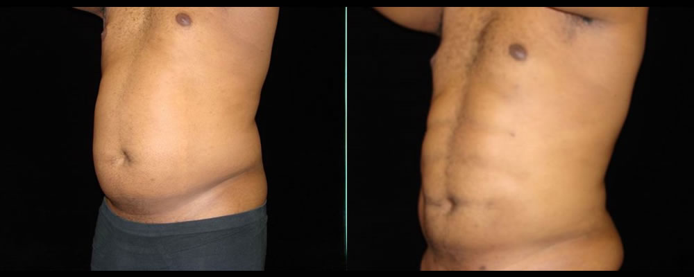 Six Pack Abs Before & After Patient #1137