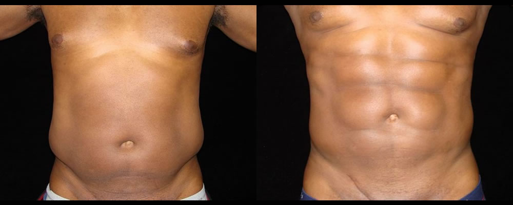 Six Pack Abs Before & After Patient #1133