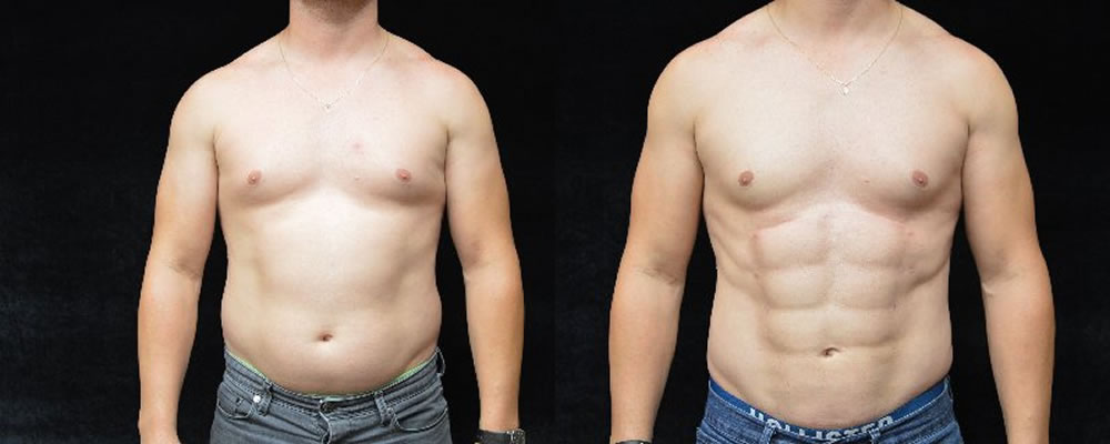 Six Pack Abs Before & After Patient #1131