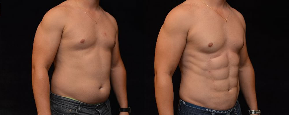 Six Pack Abs Before & After Patient #1128