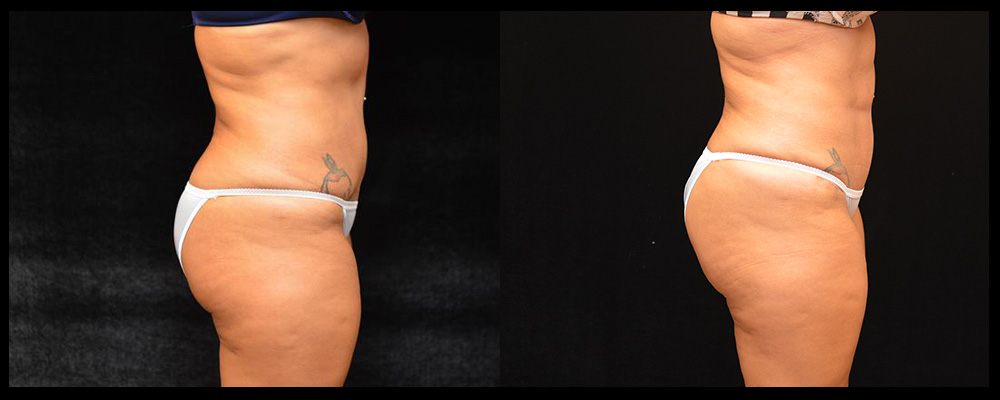 Six Pack Abs Before and After Photos Baltimore - Plastic Surgery Gallery  Columbia - Dr. Daniel Markmann