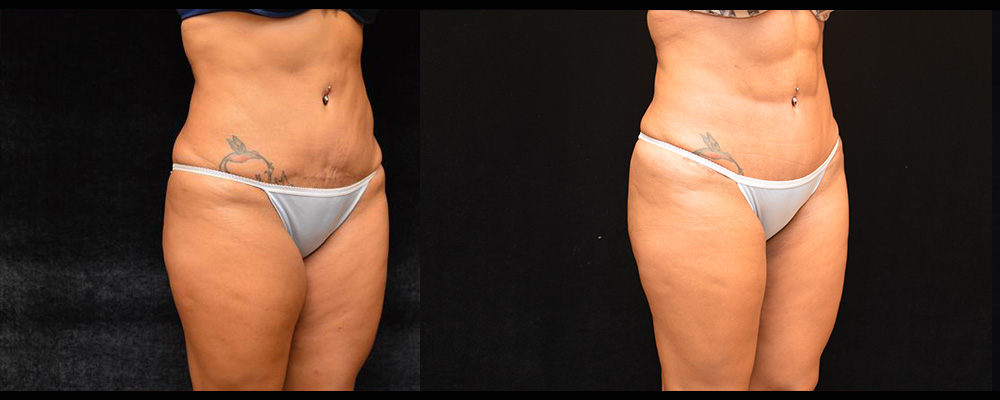 Six Pack Abs Before and After Photos Baltimore - Plastic Surgery Gallery  Columbia - Dr. Daniel Markmann