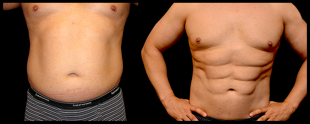 Six Pack Abs Before & After Patient #1121