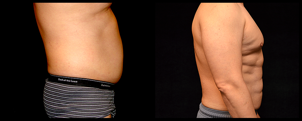 Six Pack Abs Before & After Patient #1121