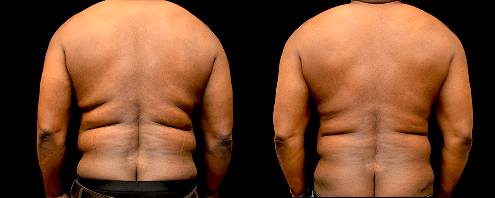 Six Pack Abs Before and After Photos Baltimore - Plastic Surgery Gallery  Columbia - Dr. Daniel Markmann