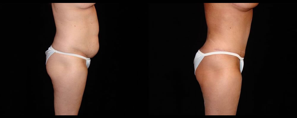 Tummy Tuck Before & After Patient #608