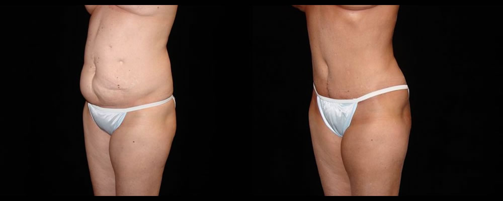 Tummy Tuck Before & After Patient #608