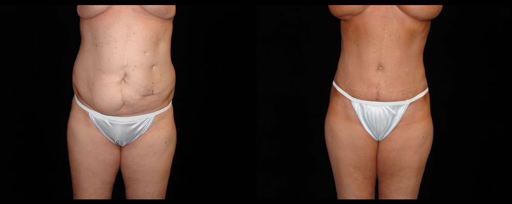 Tummy Tuck Before & After Patient #608