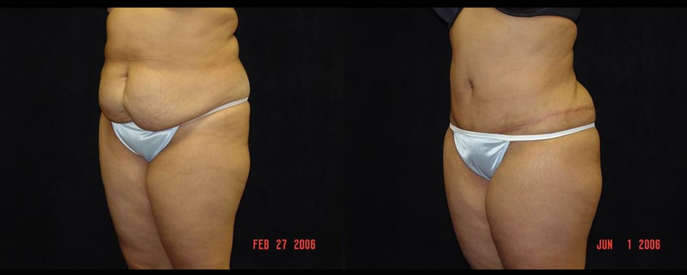 Tummy Tuck Before & After Patient #575