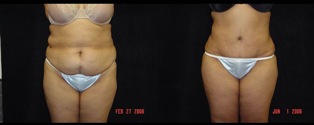 Tummy Tuck Before & After Patient #575