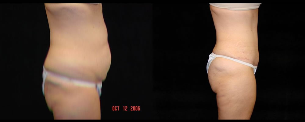 Tummy Tuck Before & After Patient #571