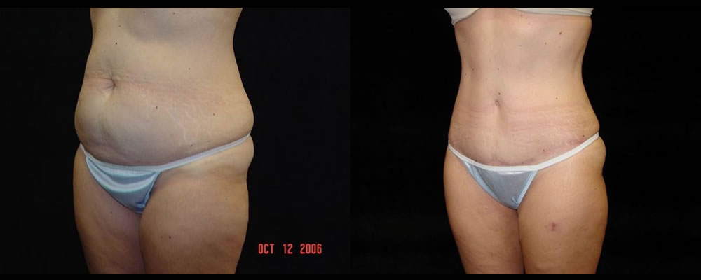 Tummy Tuck Before & After Patient #571