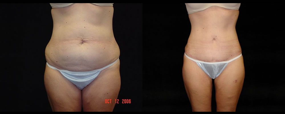 Tummy Tuck Before & After Patient #571