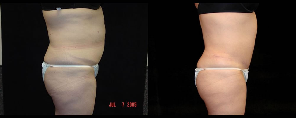 Tummy Tuck Before & After Patient #567