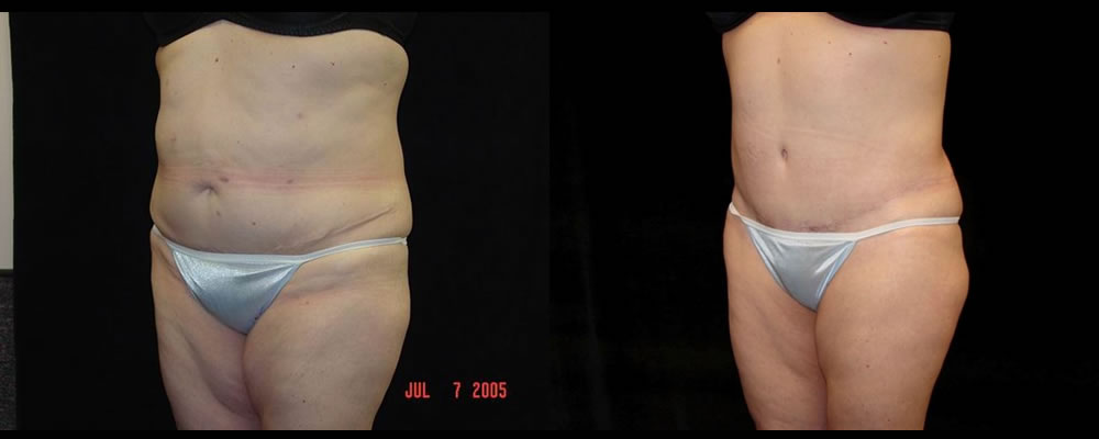 Tummy Tuck Before & After Patient #567