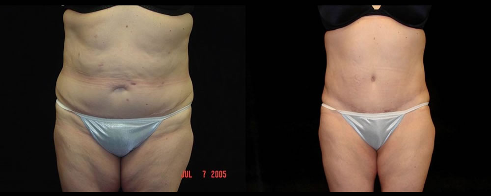 Tummy Tuck Before & After Patient #567