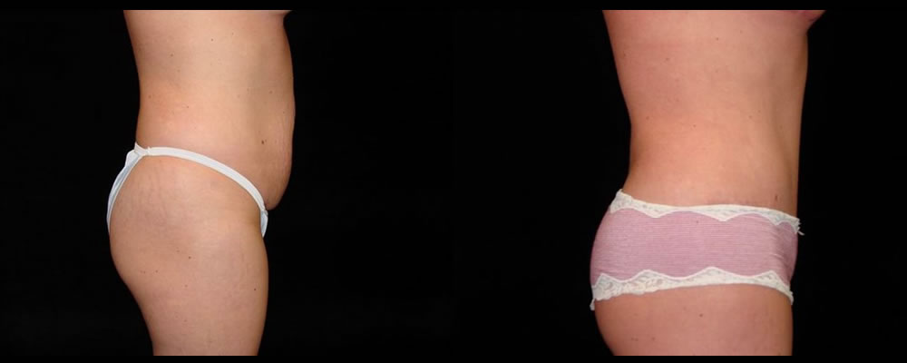 Tummy Tuck Before & After Patient #563