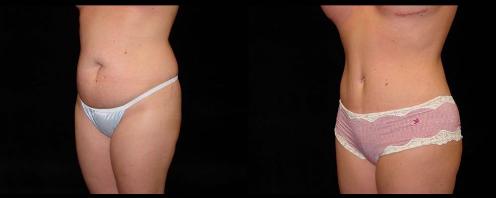 Tummy Tuck Before & After Patient #563