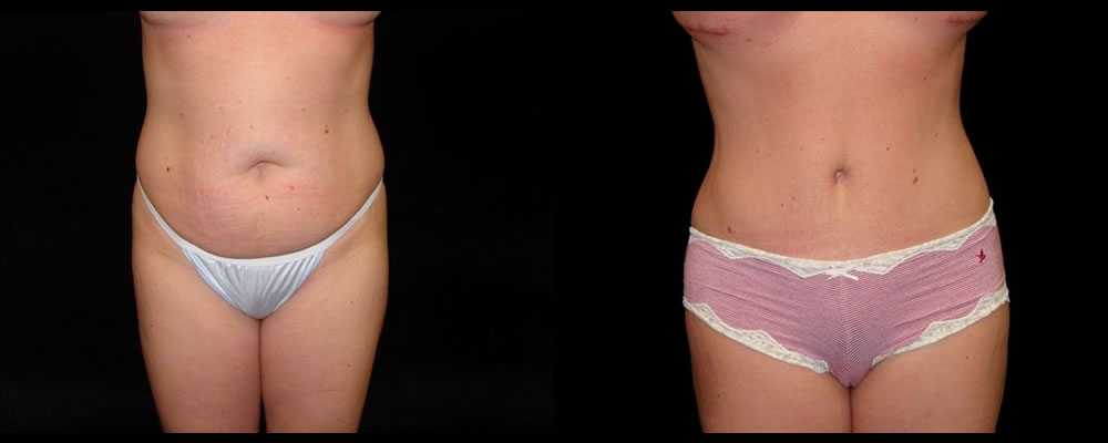 Tummy Tuck Before & After Patient #563