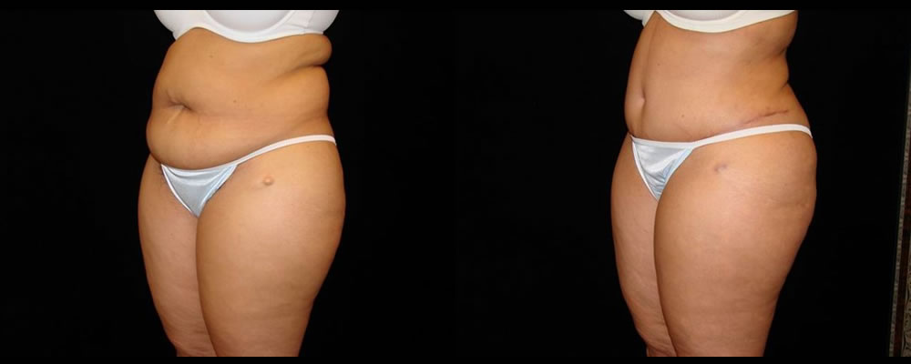 Tummy Tuck Before & After Patient #559