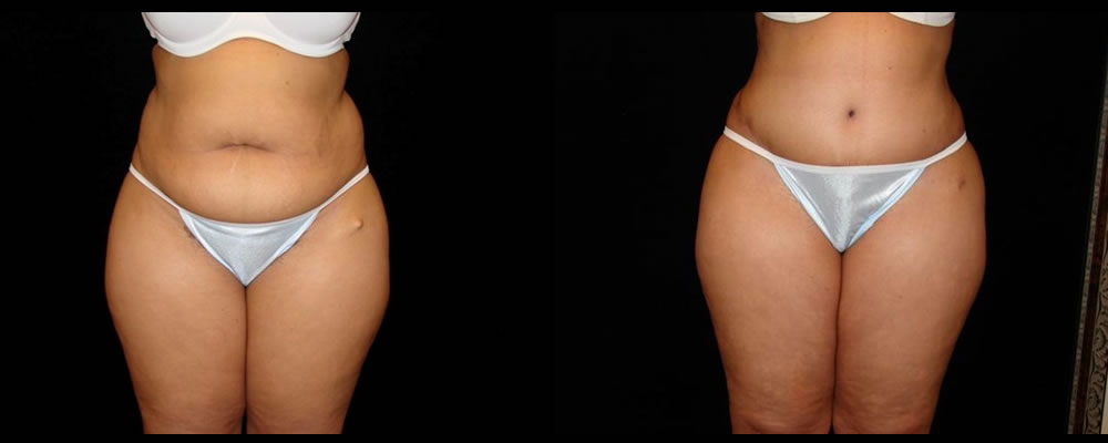 Tummy Tuck Before & After Patient #559