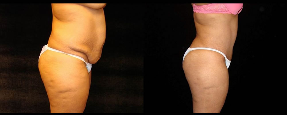 Tummy Tuck Before & After Patient #555