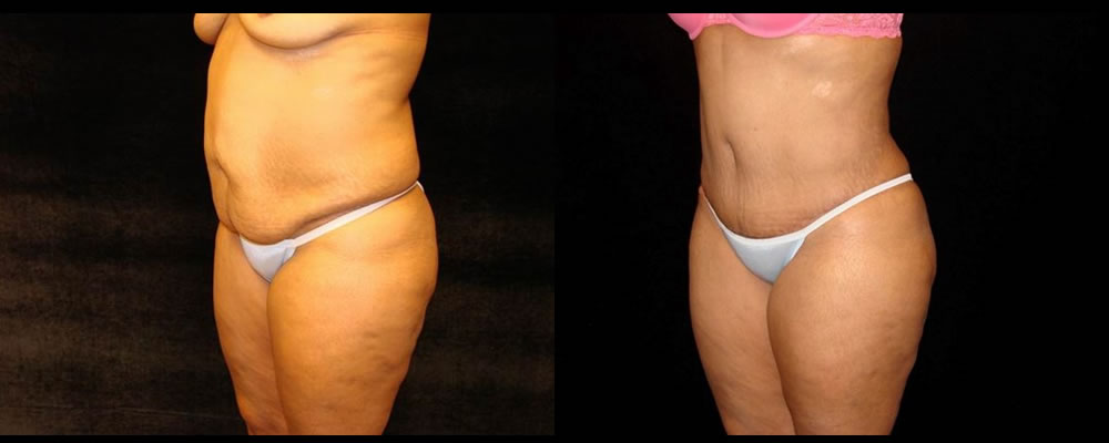 Tummy Tuck Before & After Patient #555