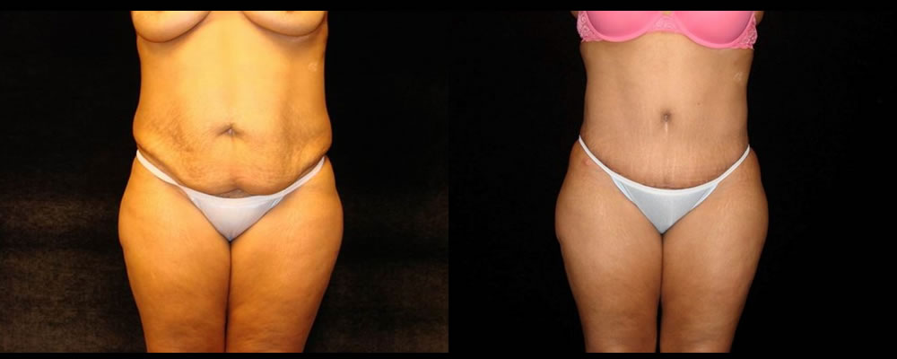Tummy Tuck Before & After Patient #555