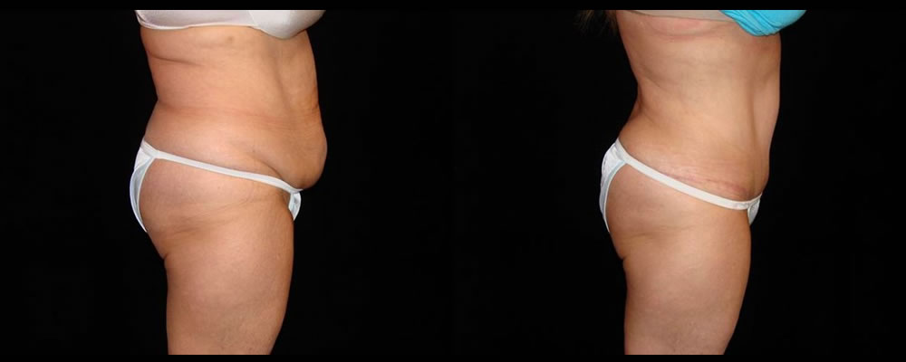 Tummy Tuck Before & After Patient #551