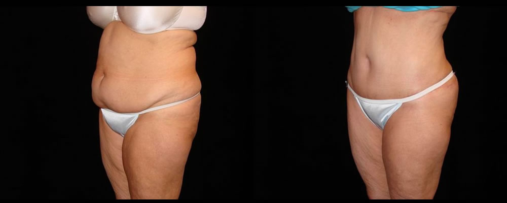 Tummy Tuck Before & After Patient #551