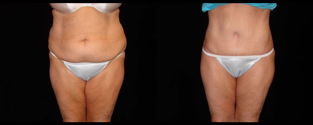 Tummy Tuck Before & After Patient #551