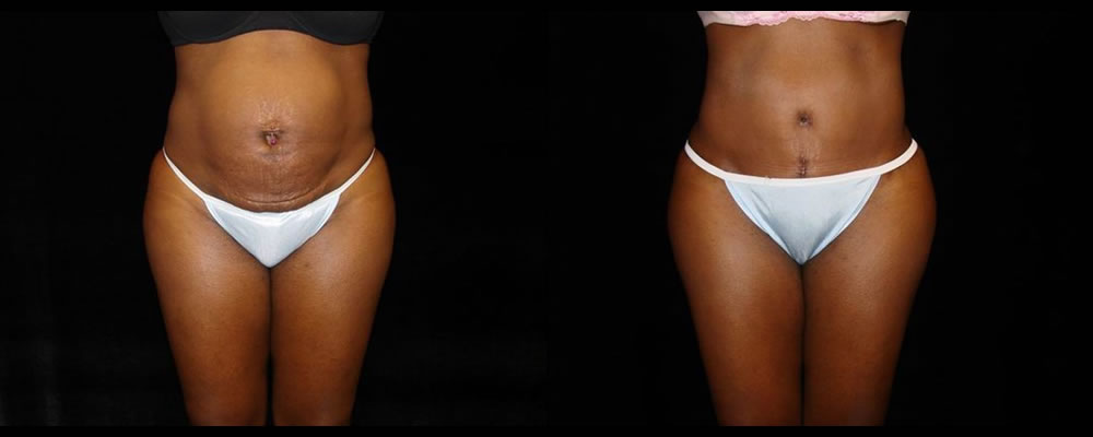 Tummy Tuck Before & After Patient #547