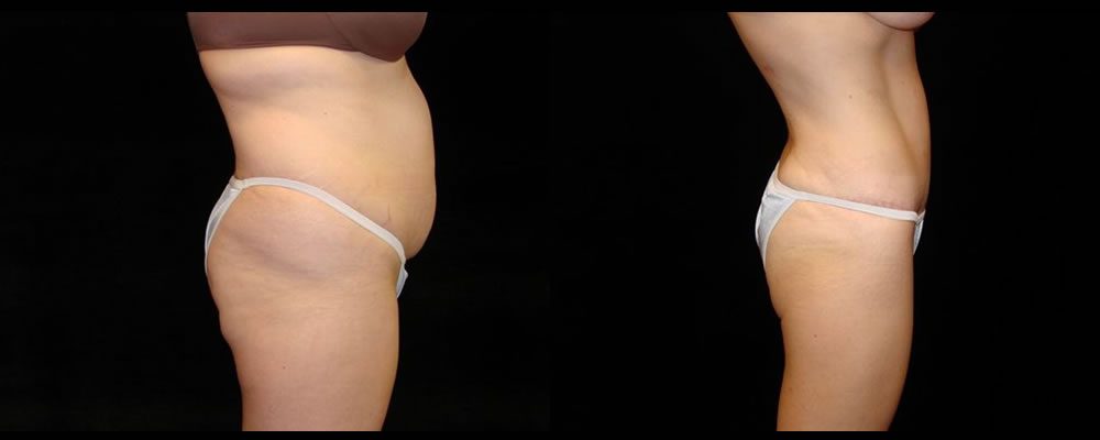 Tummy Tuck Before & After Patient #543