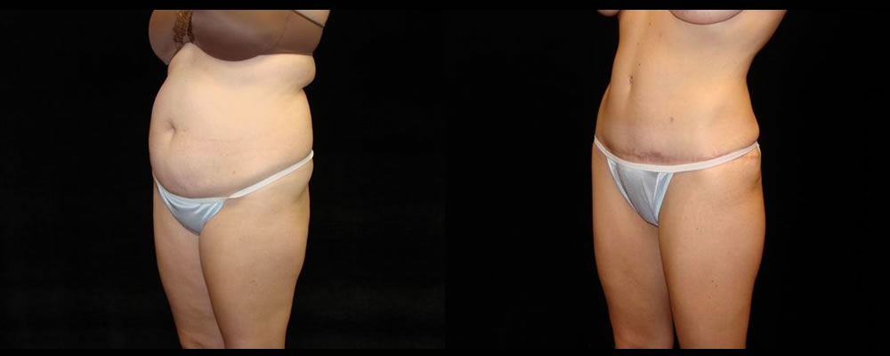 Tummy Tuck Before & After Patient #543