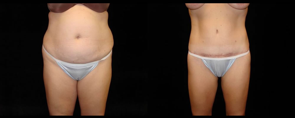 Tummy Tuck Before & After Patient #543
