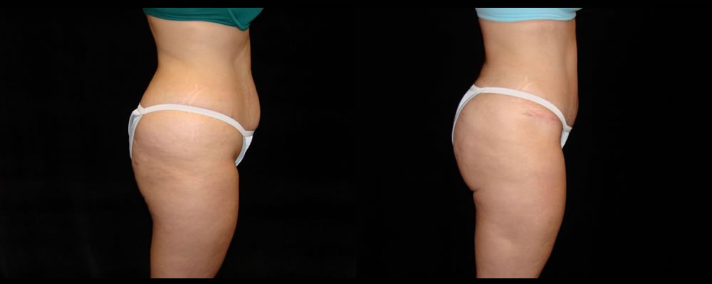Tummy Tuck Before & After Patient #539