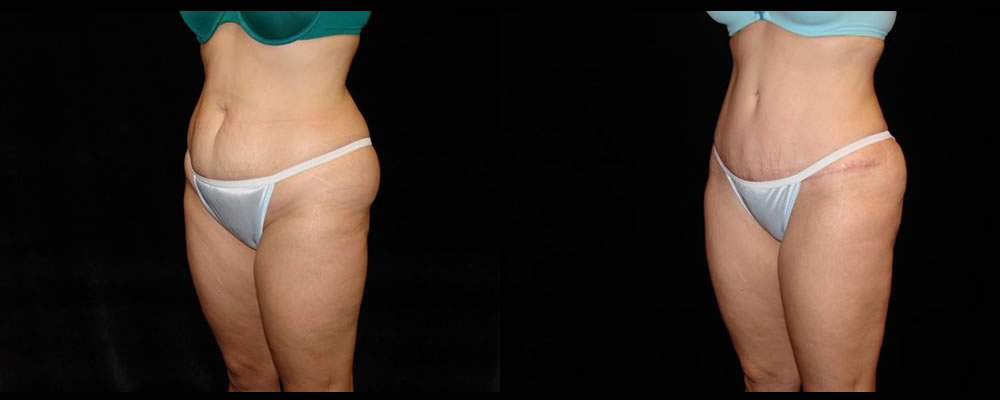 Tummy Tuck Before & After Patient #539