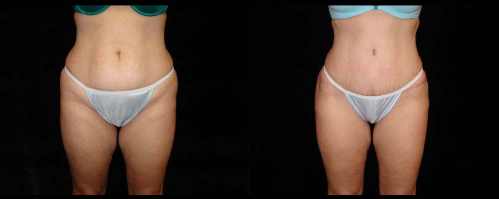 Tummy Tuck Before & After Patient #539