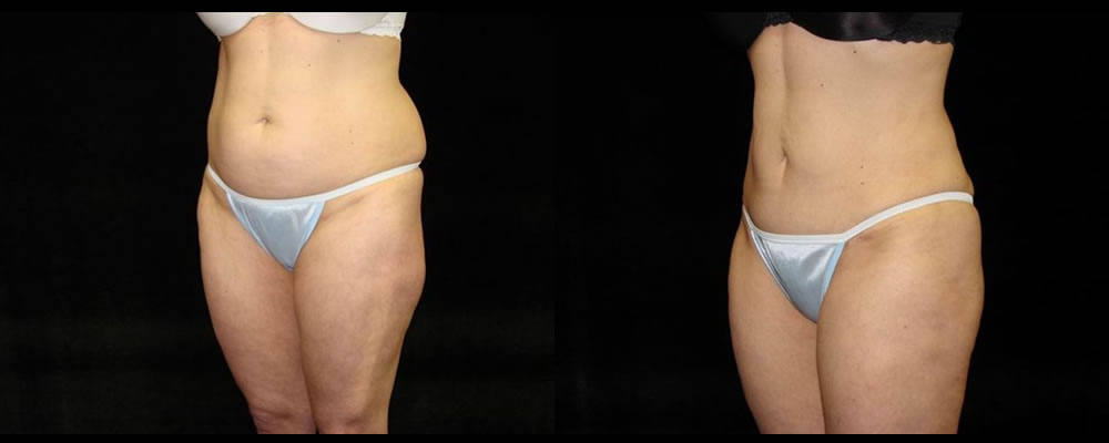 Tummy Tuck Before & After Patient #604