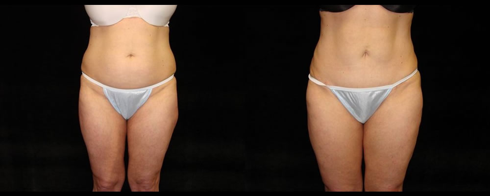 Tummy Tuck Before & After Patient #604