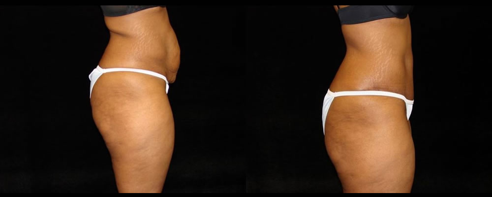 Tummy Tuck Before & After Patient #535