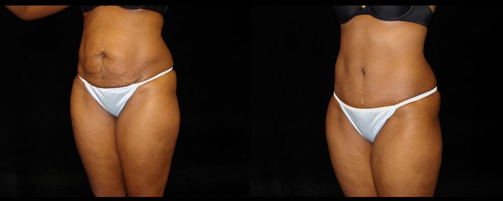 Tummy Tuck Before & After Patient #535