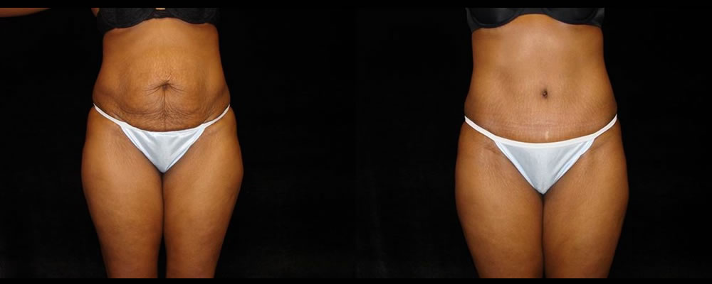 Tummy Tuck Before & After Patient #535