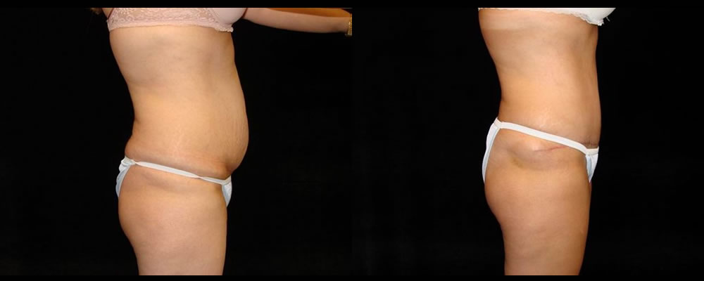 Tummy Tuck Before & After Patient #531