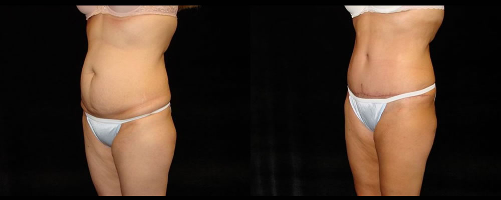 Tummy Tuck Before & After Patient #531