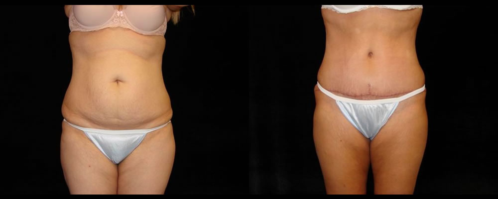 Tummy Tuck Before & After Patient #531