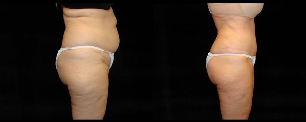 Tummy Tuck Before & After Patient #527